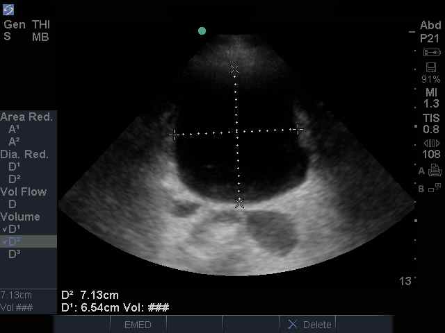 bladder AP and transverse