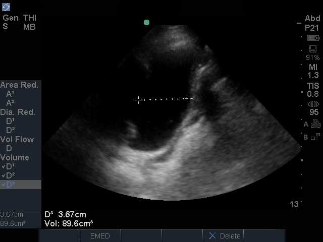bladder sagittal